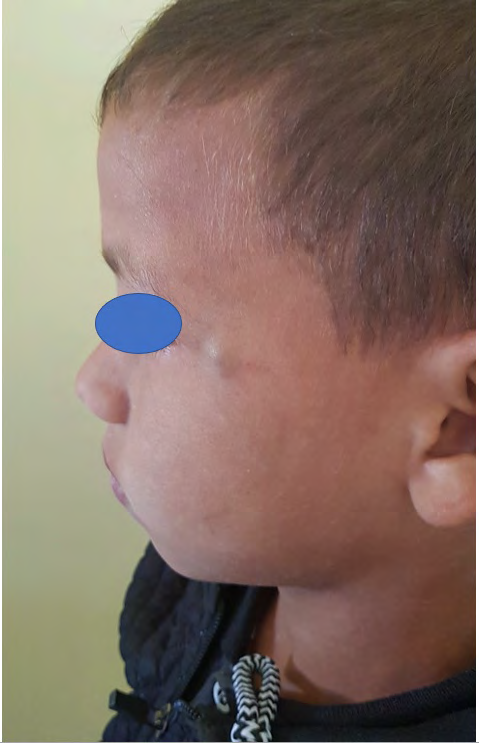 Figure 1: Clinical photo showing a bluish nodule on the face.