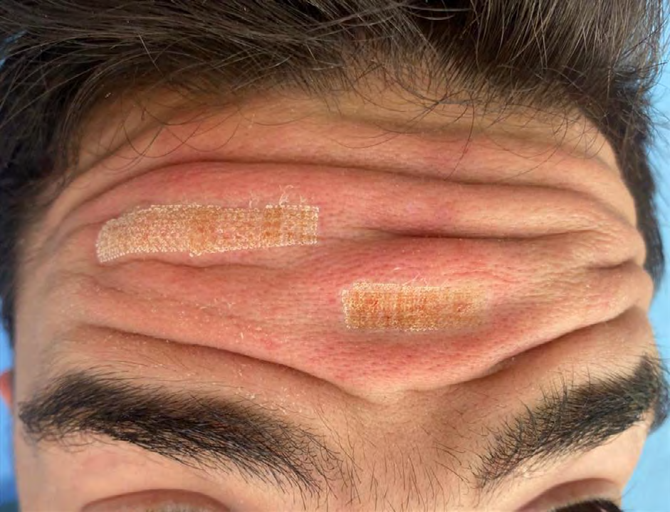 Figure 2: Front scar after a fractionated ablative laser.