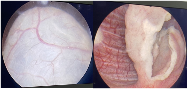 Figure 3: a: After complete resection, b: After insertion of DJ stent.