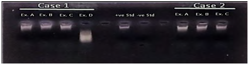 Figure 8: - The 1% Agarose gel electrophoresis results of isolated DNA Case-1 (Ex-A- Post mortem blood stain of suspected father, Ex-B- Dried umbilical cord of deceased baby, Ex-C- Blood stain of mother, Ex-D- Femur bone of deceased baby); “+ve” Std=20ng/l; “-ve” Std; Case-2 (Ex-A- Liquid blood of mother, Ex-B- Liquid blood of suspected father, Ex-C- Cord blood stain of the still born baby).