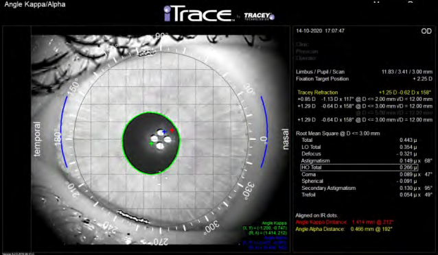 Figure 5: Result of examination of the cornea, using SOCT Copernicus REVO®, a module for cornea examination, which gives information about total (anterior and posterior) corneal astigmatism.