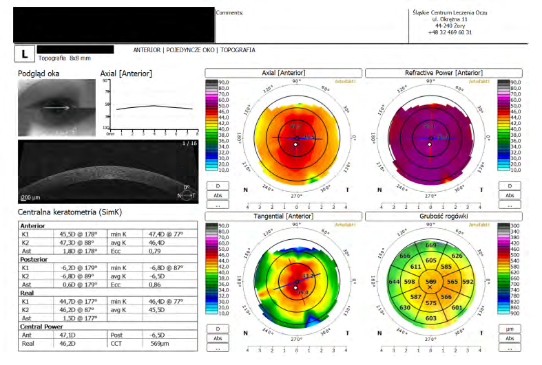 Figure 6: A result of examination using the iTrace analyser, Angle Kappa/Alpha module. Condition after implantation of the lens, positioned in accordance with the axis of angle kappa (±214°), the part responsible for vision to far distances positioned “towards the pupil”, i.e. in group 1. Reflections of light from the lens are visible in the pupil projection. The four clear points are the focus of the image on the part responsible for vision to far distances. The four blurry points are the part responsible for vision to near distances.