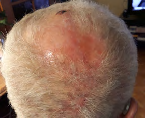 Figure 4: Complete healing with cicatricial alopecia.