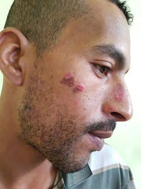 Figure 1: Erythematous and pigmented plaques with an atrophic center of patient with discoid lupus.