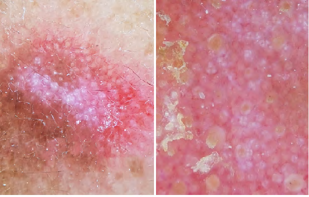Figure 2: In dermoscopy Telangiectatic vessels, White scales, Rosettes, Perifollicular whitish halo, (A) a close up in dermoscopy showing Follicular keratotic plugs (B).