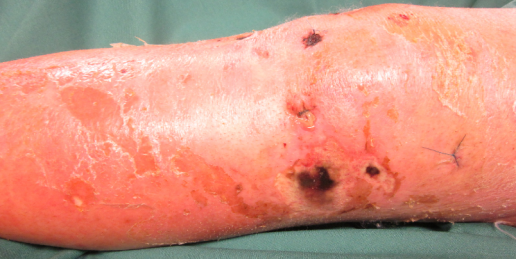 Figure 1: Left Knee joint with clinical sign of infection and skin necrosis ad admission.