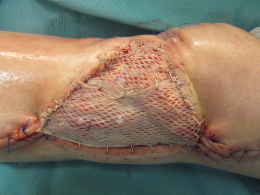 Figure 6: Left Knee joint after mesh graft transplantation 46 days after admission.