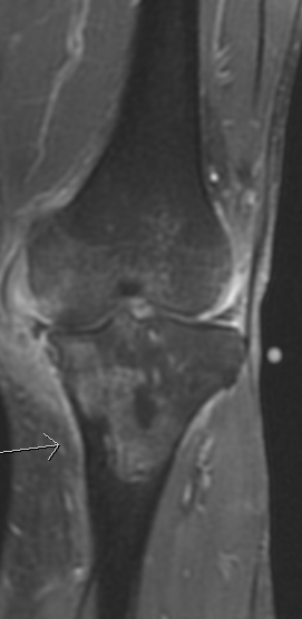 Figure 7: Follow up MRI of the left knee joint (T1 weighted image) after 6 months, showing low grade arthritis of the knee joint with low grade osteomyelitis of the proximal tibia.
