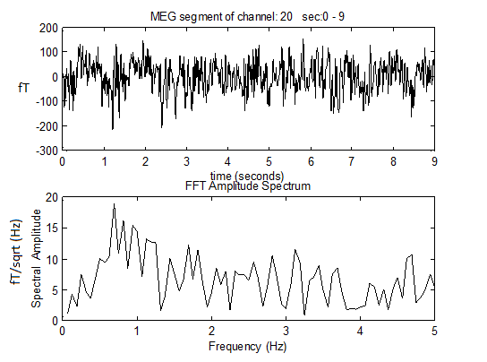 Figure 1: A) A MEG record of 9 sec obtained from a patient B) the application of FFT on the MEG record Analysis and Prediction of Sham and Stimulus Runs As it was indicated before in session 2 there are 3 data sets (run1, run2, run3) and the task is to identify where the sham stimulation was delivered (before recording run2 or before recording run3). Based on the frequency differences across all channel groups it was possible to make a prediction of the likely stage (run2 sham or run3 sham) of pT-TMS in each of the 10 recordings MEG depression patients.