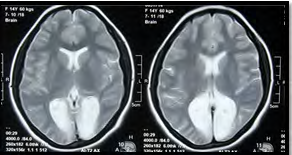 Figure 2: MRI of brain showing Schizencephaly.