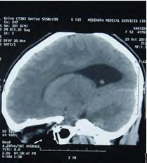 Figure 3: MRI of brain showing Procencephalic cyst.