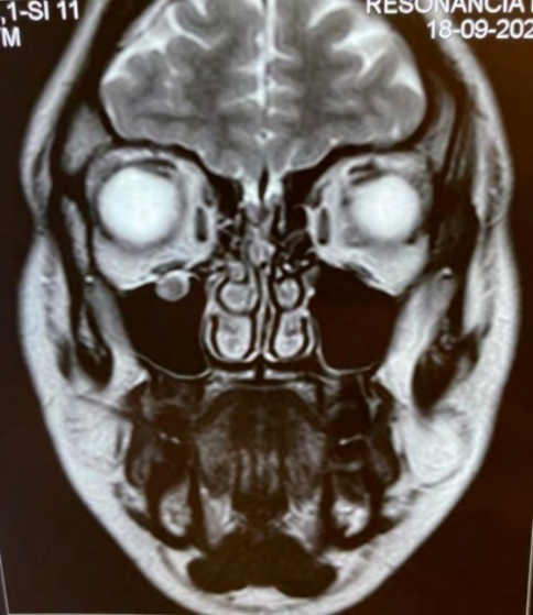 Figure 1: MRI Displaying a Round-Shaped Image Contacting the Right Infraorbital Nerve.