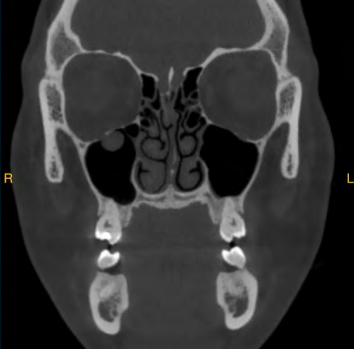 Figure 2: CT showing Hypodense Round Image Contacting the Infraorbitary Canal.