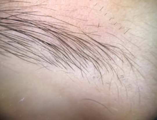 Figure 3: Figure showing the regression of trichoscopic signes of Tinea Capitis.