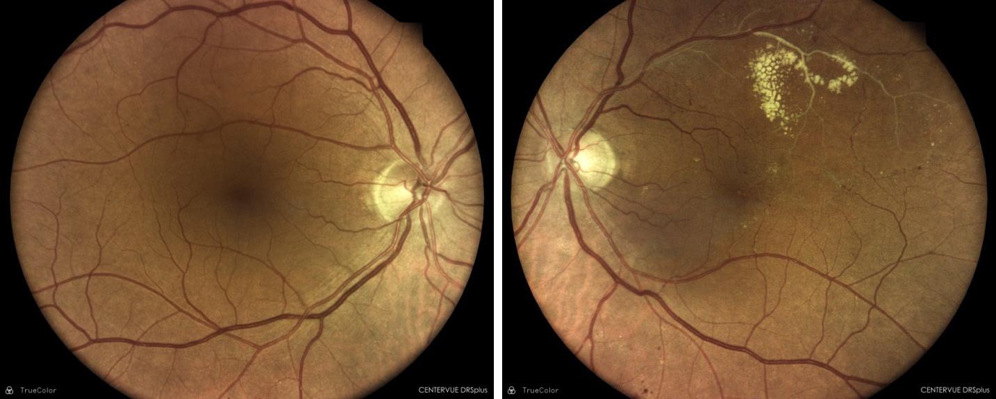 Figure 1: Two photographic image field were taken of each eye, one centered on the optic disc and the other on the macula.
