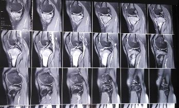 Figure 2: MR images of the left knee showing extent of growth and tissue oedema. Biopsy was done, and the lesion was diagnosed as high grade osteosarcoma. We started her on neoadjuvant chemotherapy, combination with cisplatin and adriamycin. We performed resection of the left upper tibia and arthroplasty with megaprosthesis (Figure 3). She was mobilized on next day but knee bending was not allowed. Stitches were removed 15 days postoperatively. After 4 weeks she was allowed knee bending with good return to daily activities.