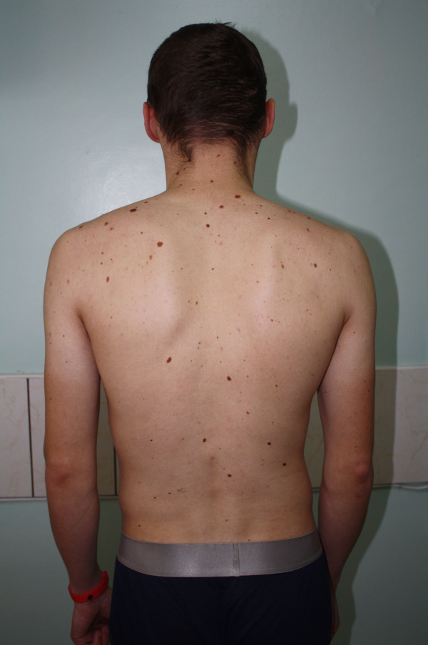 Figure 2: Multiple melanocytic nevi on the skin of the back.