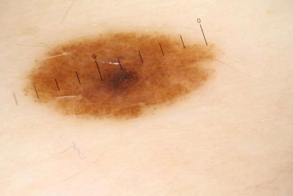Figure 4: A symptom of “sunny side up eggs”.