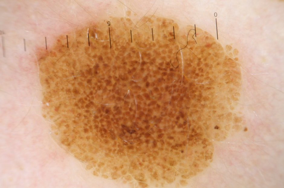 Figure 5: Melanocytic spot with a typical reticular pattern.