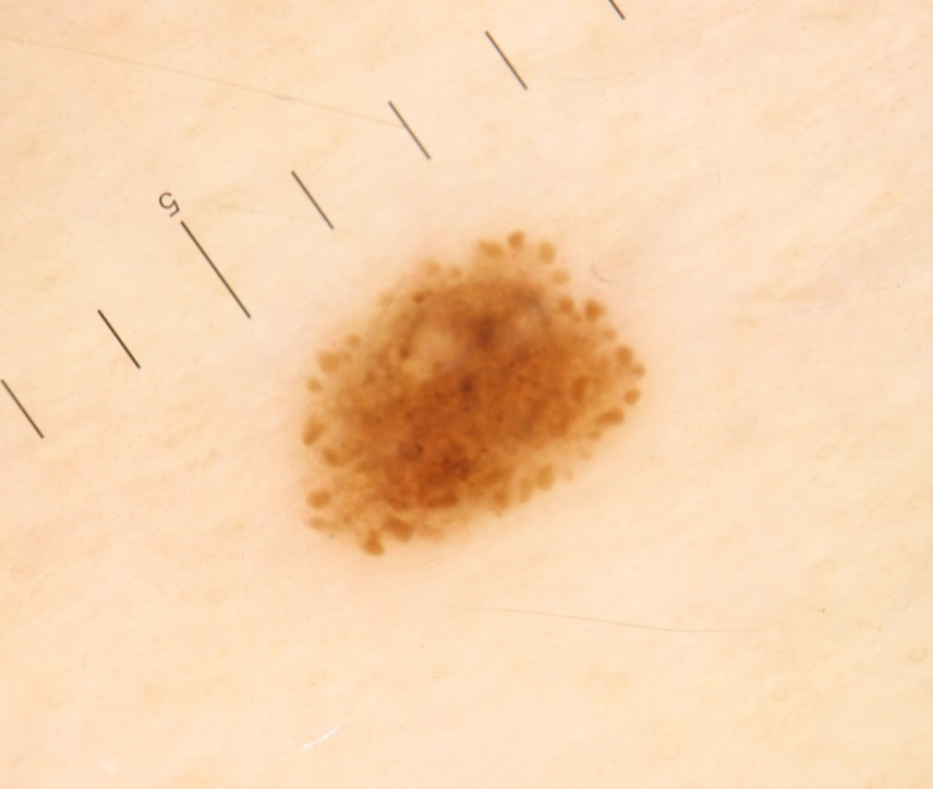 Figure 6: Melanocytic spot with globules along the periphery of the formation.