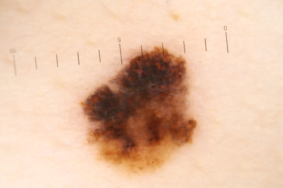 Figure 7: Suspitio melanoma.