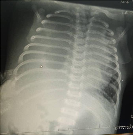 Figure 1: Chest x-ray showing right lung collapse with tension haemopneumothorax and a mediastina shift to the left.