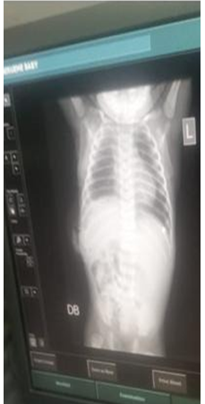 Figure 3: Chest X-ray with lungs expanded.