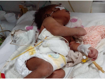 Figure 4: Drainage of air and straw colored fluid after insertion of improvised chest tube. Tubing crossed by infusion set delivering intravenous fluids via an umbilical vein catheter.