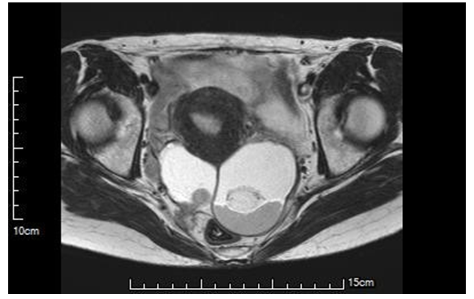 Figure 1: Enhanced CT findings. Two cystic tumors are found at the back of uterus. A 6.9 x 6.2 cm tumor in her left ovary and a 5.0 x 4.2 cm one in her right ovary, suggesting ovarian mature cystic teratomas, however rt-ovarian tumor had been suspected to invade to the rectum, suggesting malignant transformation.