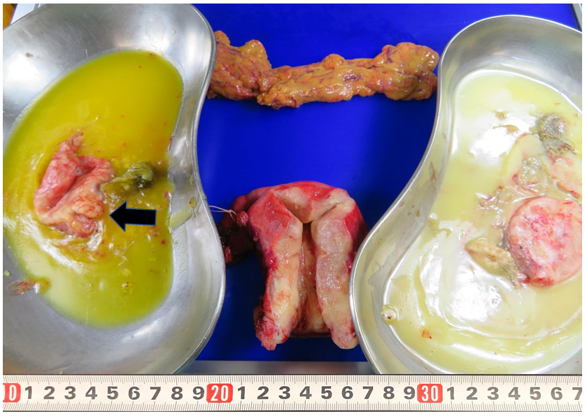 Figure 2: Macroscopically, bi-lateral ovaries appeared “mature cystic teratomas.” The right ovary had a ridged part (2.2 x 1.4 cm, arrow), which showed bleeding in part.
