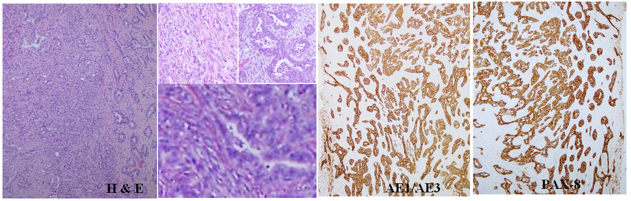 Figure 4: ** A) Photomicrograph of the ridged part in the right ovary (H&E stain, x 50). The left two-thirds showed pleomorphic sarcoma and the right one-thirds revealed adenocarcinoma. B) Left upper showed pleomorphic sarcoma (H&E stain, x 100). Right upper showed adenocarcinoma (H&E stain, x 100). Under showed intermixing of the two components (H&E stain, x 400. C) Immunohistochemical stainings with AE1/AE3 were positive in the both sarcomatous and adenocarcinoma elements (sABC stain, x 50). D) Immunohistochemical stainings with Pax-8 were also positive for the both sarcomatous and adenocarcinoma elements (sABC stain, x 50).