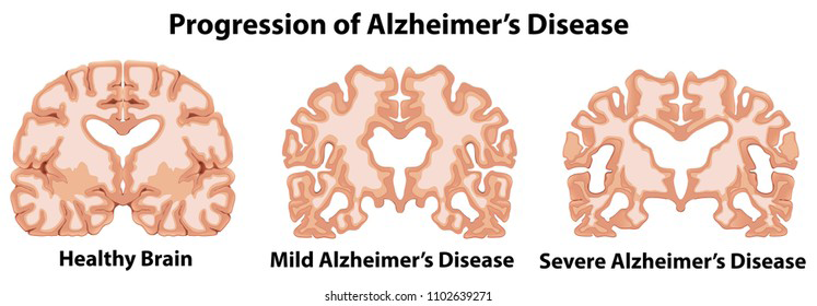 Figure 2: Progression of Alzheimer’s Disease.