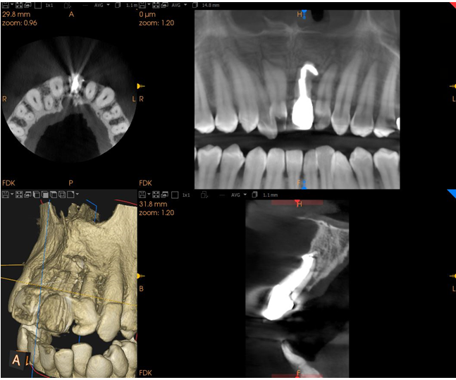 Figure 1: Pre-operative radiograph showing failing endodontically treated central incisor.