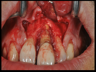 Figure 4: Bone augmentation with Bio-oss bone particles and Bio-gide membrane.