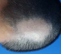 Figure 3: 2nd triamcinolone injection treatment (18/10/2021), with 20 mg of Prednisone for 2 weeks