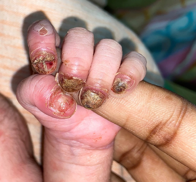 Figure 1: Palmar grasp reflex - a neonate tightly holding on to the examiner’s finger with clear picture of all the five digit nail.
