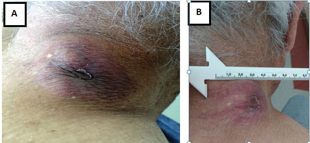 Figure 1: A: The nodule on the neck. B: Nodule is measuring 36-48 millimeters in greatest dimension.