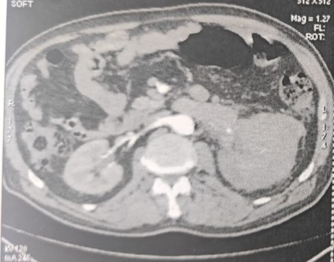 Figure 1: Left Renal Process.