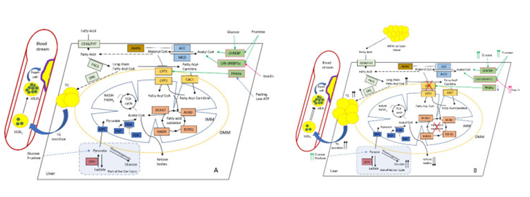 Figure 4: Courtesy ref no-55-Altered hepatic lipid metabolism in normal (A) and NAFLD; (B) conditions. Increased diet supply of glucose and fructose affects ChREBP (carbohydrate-responsive element-binding protein), SREBP1c (sterol regulatory element-binding protein-1c), and LXR (liver X receptor) TFs, which stimulate malonyl CoA synthesis. PPARα (peroxisome proliferator-activated receptor alpha) normally activates CPT1 under fasting and low-ATP conditions. As a key intermediate, malonyl CoA inhibits CPT1, thus reducing FAO. This leads to the accumulation of long-chain fatty-acid CoA (which could also be delivered from surplus adipose tissue), and stimulates DNL with the subsequent rise in intrahepatic TG and plasma TG levels, further increasing large VLDL1 and the formation of small dense LDL, which favours foam cell formation and ultimately atherosclerosis. During the progression of NAFLD, the production of ketone bodies progressively reduces while hepatic glucose synthesis and output increases, thus further promoting IR and the rise in insulin level. Colour coding as follows: PPARα and other TFs are depicted in pale green; primarily FA-metabolising enzymes (FAT (fatty-acid translocase) and FACS (fatty-acid synthase)) and DNL (de novo lipogenesis) are highlighted in pale blue; malonyl-CoA-metabolising enzymes ACC (acetyl-CoA carboxylase) and MCD (malonyl-CoA decarboxylase) are highlighted in blue; CPT system enzymes (CPT1, CPT2, and CACT) are depicted in light brown; AMPK (AMP-activated protein kinase), the main regulator of CPT system are depicted in brown; FAO enzymes ACAA2 (acetyl-CoA acyltransferase 2), ACAD (acyl-CoA dehydrogenase), ECHS1 (enoyl-CoA hydratase, short chain 1), and HADH (hydroxyacyl-CoA dehydrogenase) are depicted in in pale red; pyruvate metabolism enzymes MPC (mitochondrial pyruvate carrier 1), PDP (pyruvate dehydrogenase phosphatase), PDH (pyruvate dehydrogenase), and PDK (pyruvate dehydrogenase kinase) are depicted in dark blue; and LDH (lactate dehydrogenase) is depicted in red. Abbreviations: IMM and OMM, inner and outer mitochondrial membrane, respectively.