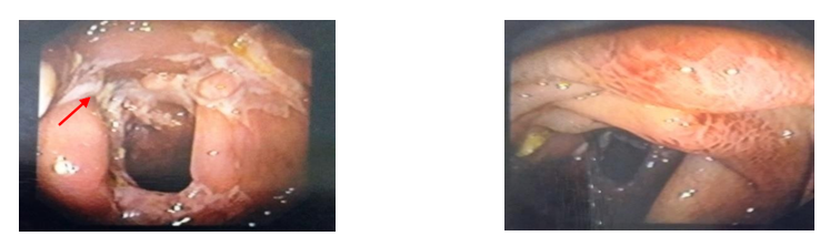 Figure 3: Ileocolonoscopy revealing ulcerative ileocecal valve with stenosis (↑).