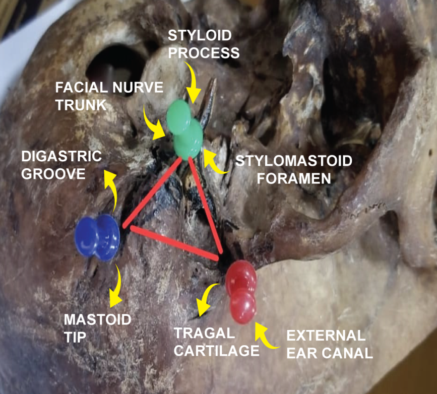 Figure 1: SP= Styloid Process, SMF = Stylomastoid foramen, TMS=Tympanomastoid suture DG=Digastric Groove.
