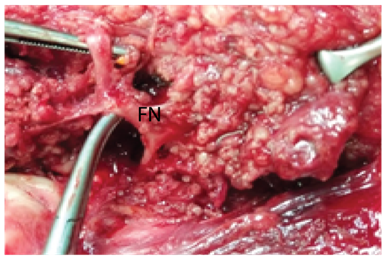 Figure 4: TP= Tragal Pointer, RMV= Retromandibular Vein.