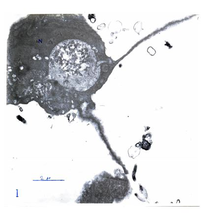 Figure 1: Monocyte with digitations. (N): Nucleus.