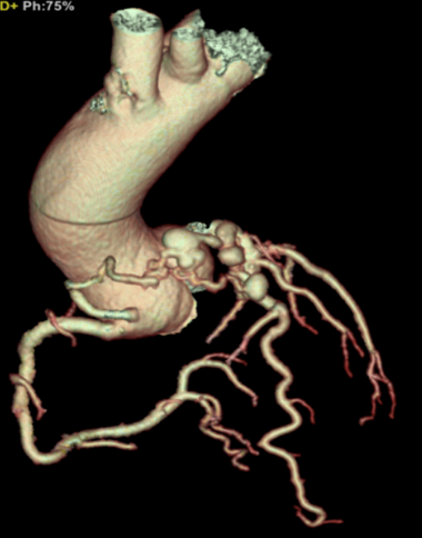 Figure 1: CTA volume rendering; the vessel arising from right coronary sinus and feeding the large vascular malformation is beautifully depicted, as well as multiple aneurysmatic pouches.