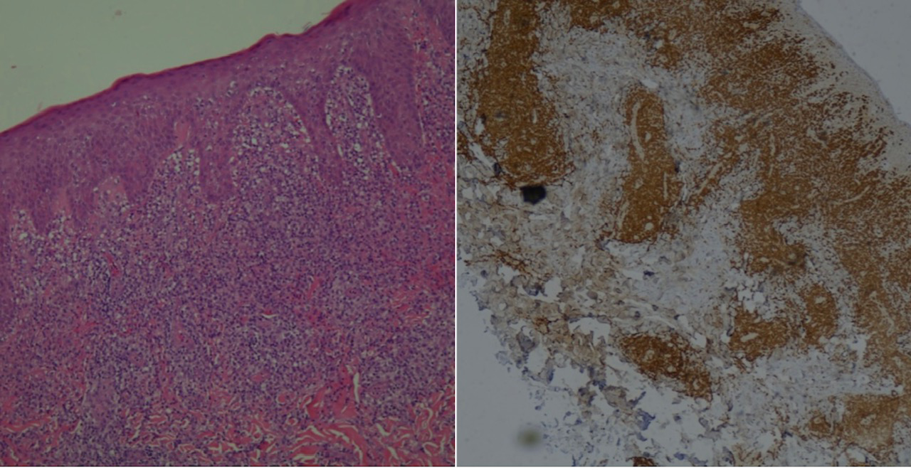 Figure 2: Histopathology and CD30 + Immunohistochemistry