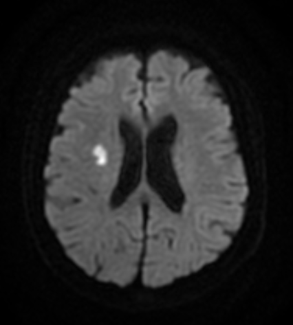 Figure 1: DWI MRI showing acute infarct in right central semiovale.