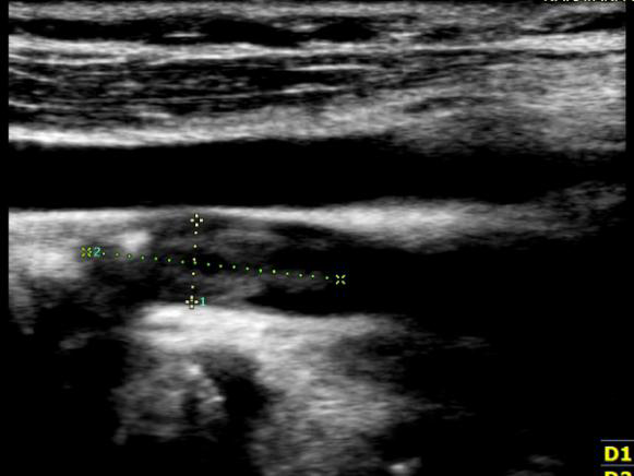 Figure 4: Doppler ultrasound image of right proximal internal carotid artery showing heterogenous plaque causing severe narrowing of the vessel.