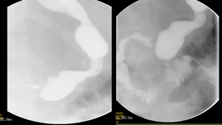 Figure 1: Case 3: Upper GI series (left) done showing gastric twist at the level of the incisura angularis, and another one (right) after management with Roux-en-Y gastric bypass.