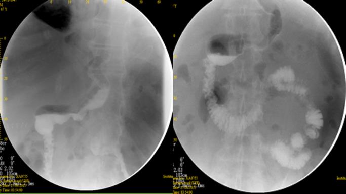 Figure 2: Case 4: Upper GI series (left) done showing gastric twist at the level of the incisura angularis, and another one (right) after management with mini bypass.