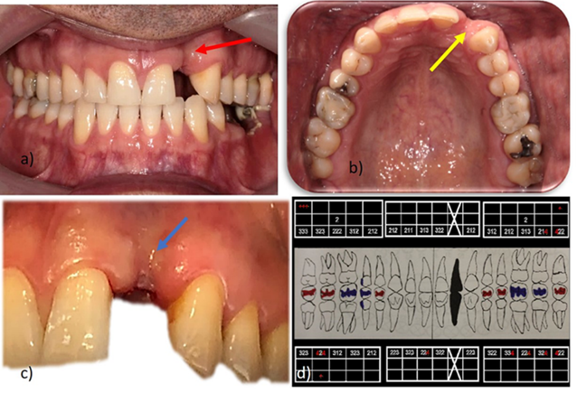 Figure 2: Initial clinical evaluation; a) healthy peripheral tissues showing vestibular collapse of the upper left lateral incisor (red arrow); b) occlusal view of the collapse in the edentulous area (yellow arrow); c) absence of keratinized tissue in the vestibular area of the upper left lateral (blue arrow); d) periodontogram.